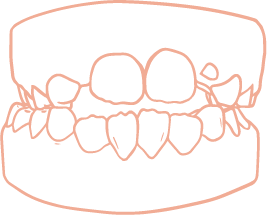 mordida-cruzada-posterior-r