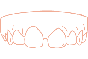 diastema-r