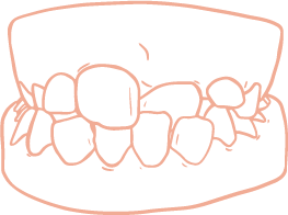 mordida-cruzada-anterior-r